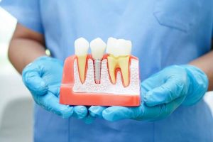 Is a Dental Implant Right for You? Discover Options in Fort Worth